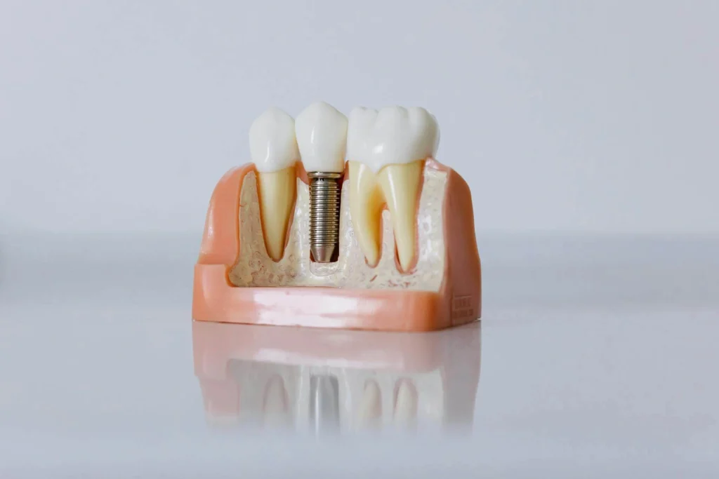 Implantaten bij International Dental Center Nieuwegein