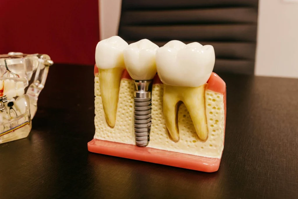 Implantaten bij International Dental Center Nieuwegein