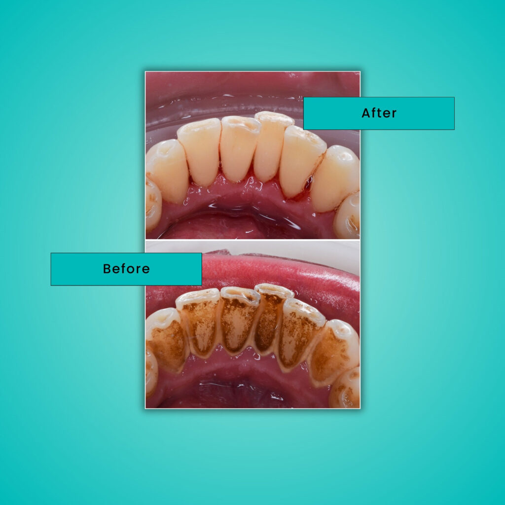  Professional teeth cleaning procedure at International Dental Center