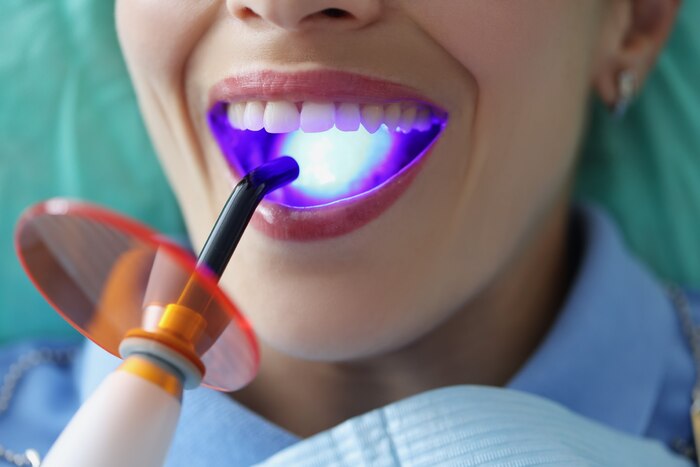 What Is Teeth Whitening and How It Works