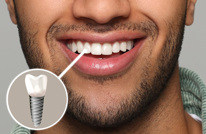 The life-changing result of an affordable dental implant cost