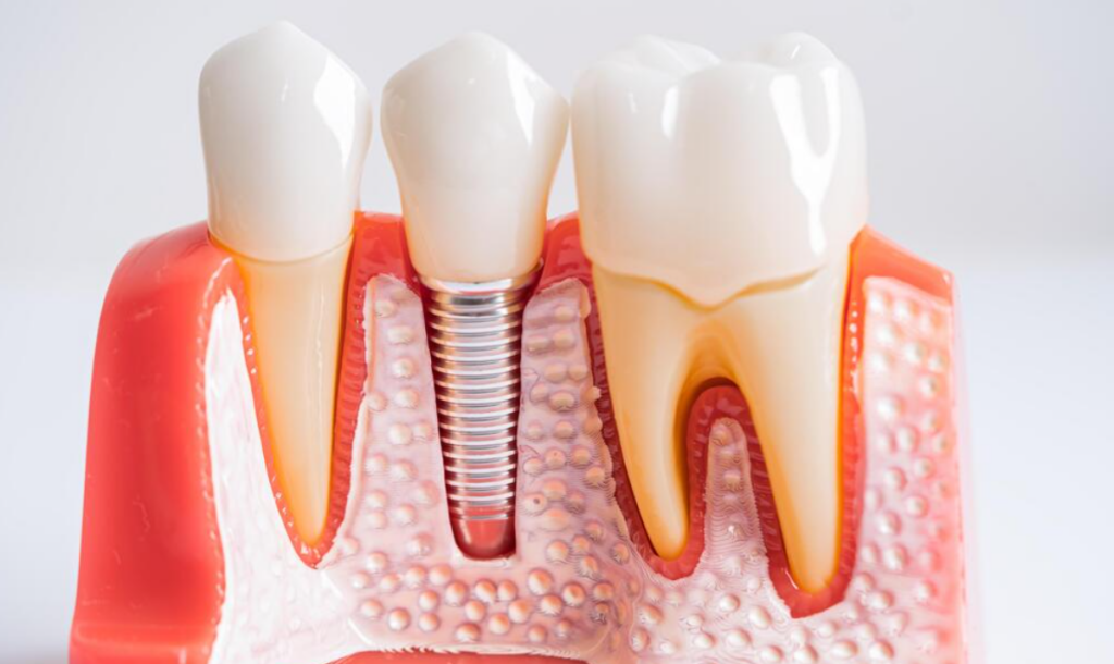 Best Dental Implants Near Me | International Dental Center